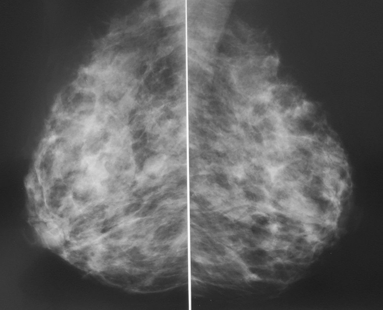 Мастопатия на снимках маммографии
